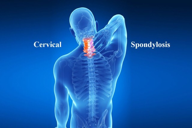 Spondylosis Neck Pain